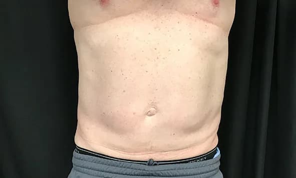 CoolSculpting Elite, abdomen, after