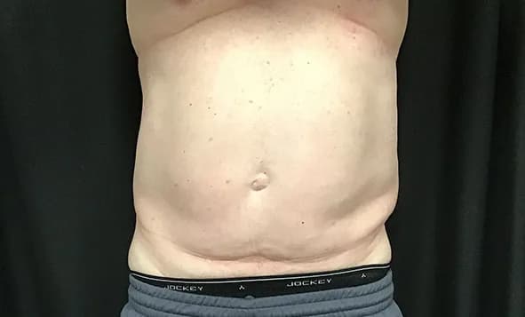 CoolSculpting Elite, abdomen, before