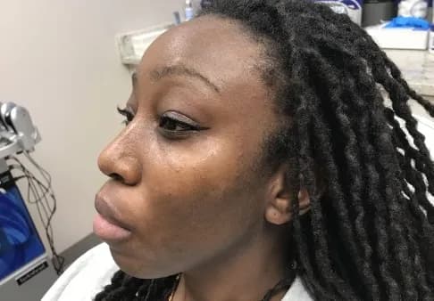 Cosmelan for melasma, side profile, before