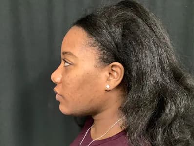 Cosmelan, side profile, after