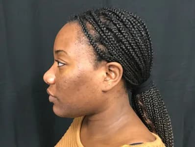 Cosmelan, side profile, before