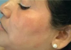 Cosmelan, cheek melasma, 80 days, after
