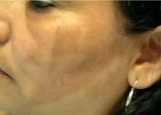 Cosmelan, cheek melasma, 80 days, before
