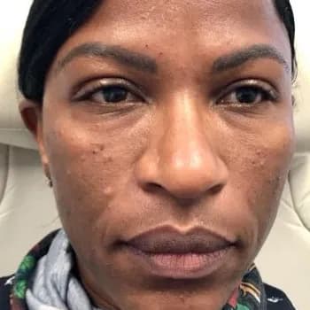 Facial filler, under-eye area, after