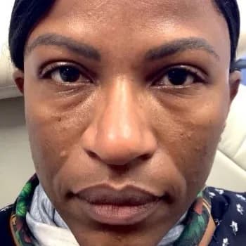 Facial filler, under-eye area, before