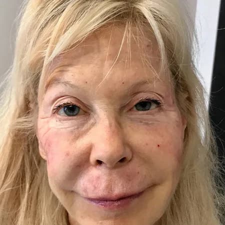 Facial rejuvenation with filler, after