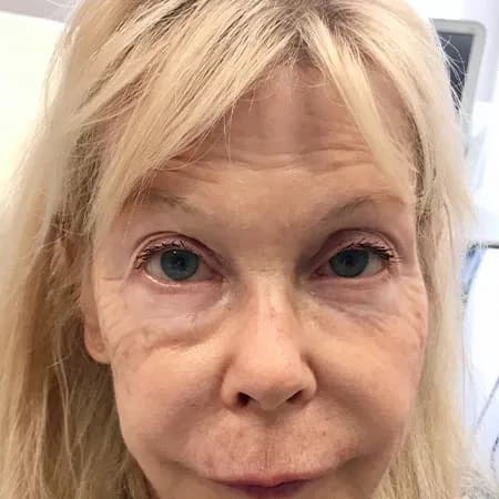 Facial rejuvenation with filler, before