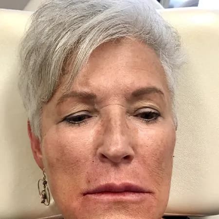 Lip and perioral filler, after