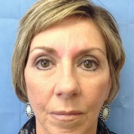Facial filler, full face, after