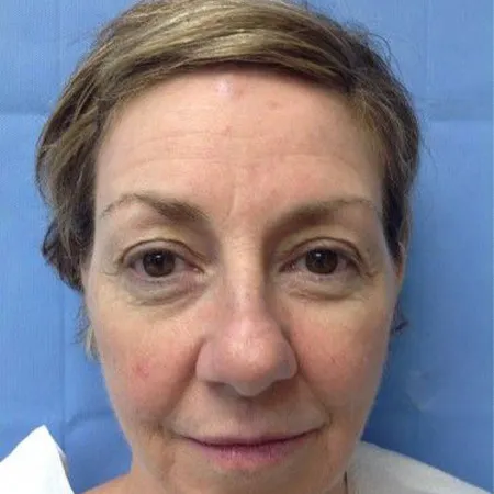 Facial filler, full face, before