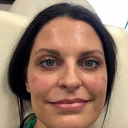 Cheek and lip filler, after