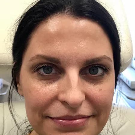 Cheek and lip filler, before