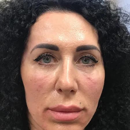 Cheek filler, after