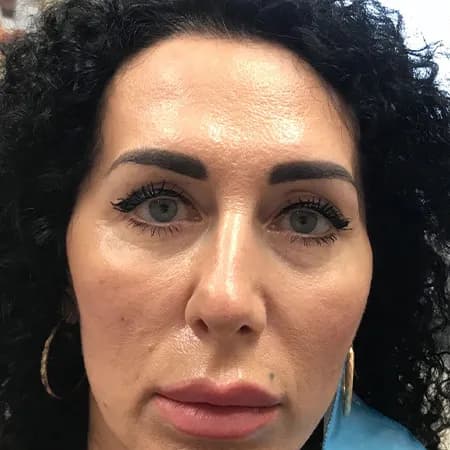 Cheek filler, before