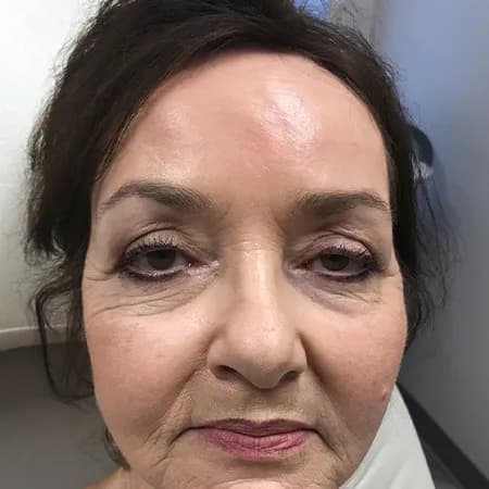 Perioral filler, after