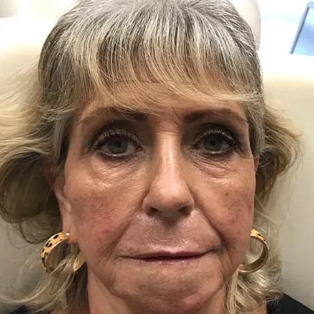 Under-eye and midface filler, after