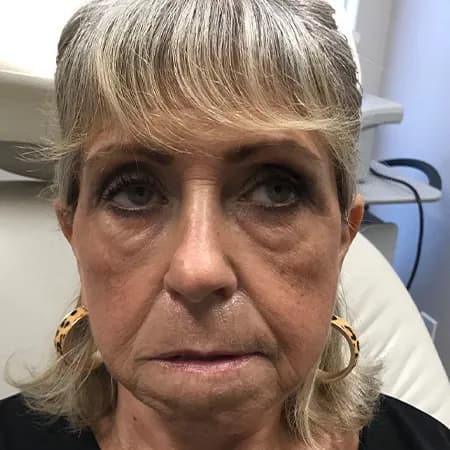 Under-eye and midface filler, before