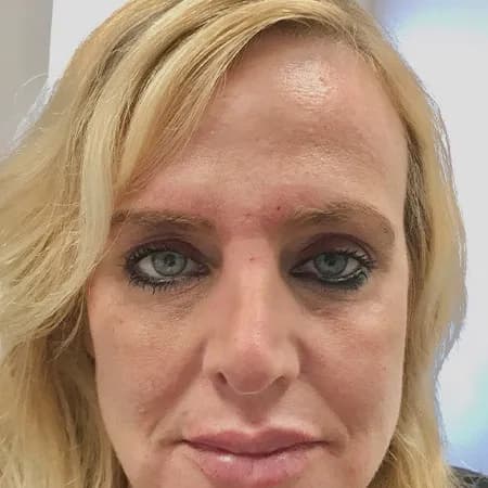 Under-eye and lip filler, after