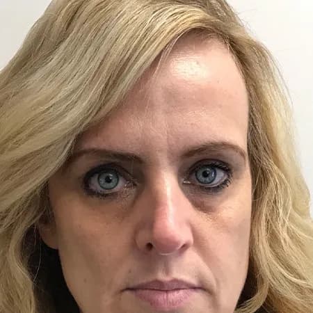 Under-eye and lip filler, before