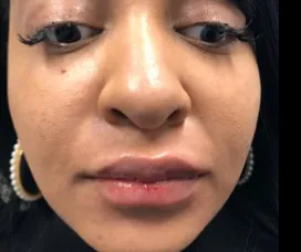 Lip filler, after