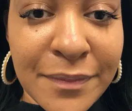 Lip filler, before
