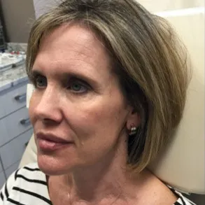 Injectable facial rejuvenation, side view, after