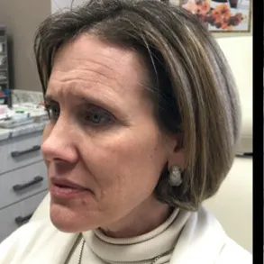 Injectable facial rejuvenation, side view, before
