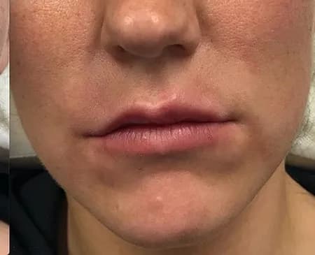 Lip filler, after