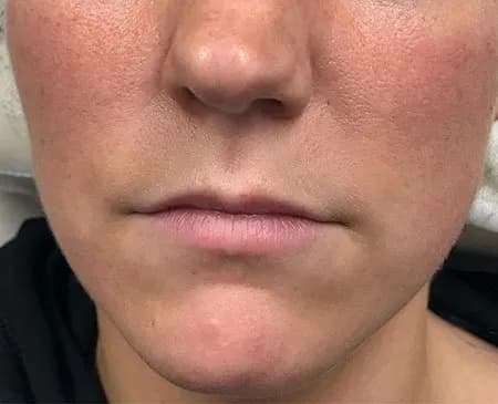 Lip filler, before