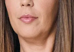 Lip filler, after