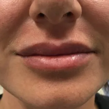 Lip filler, close-up, after