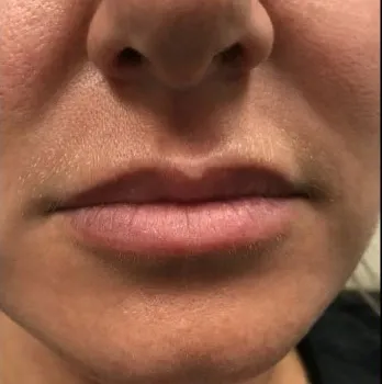 Lip filler, close-up, before