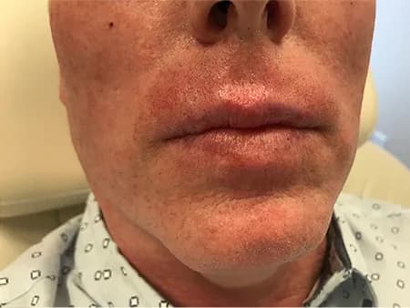 Lip filler, male patient, after