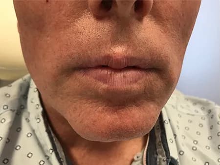 Lip filler, male patient, before