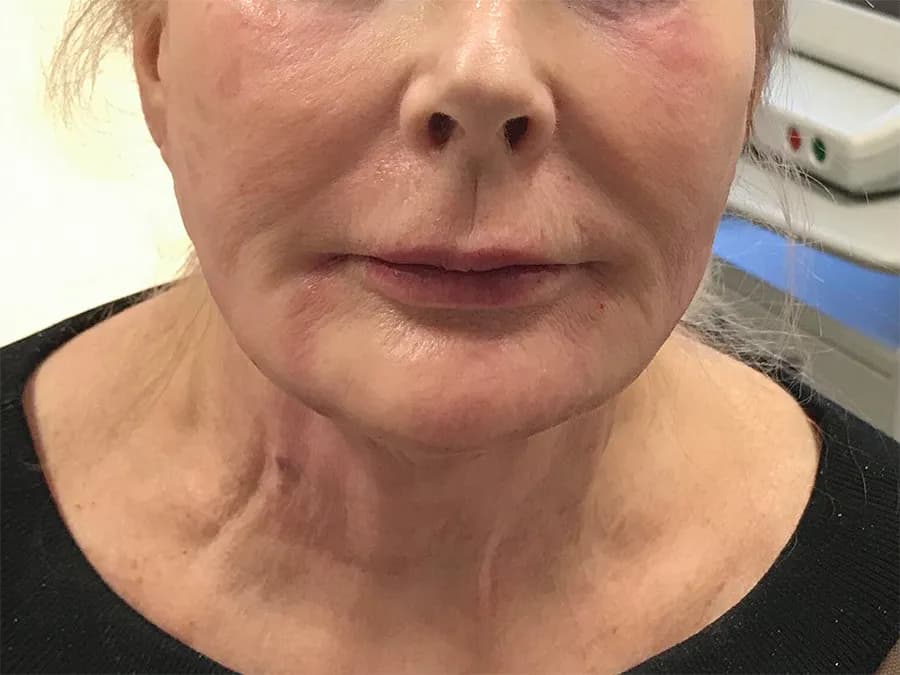 Facial filler, lower face and jawline, after