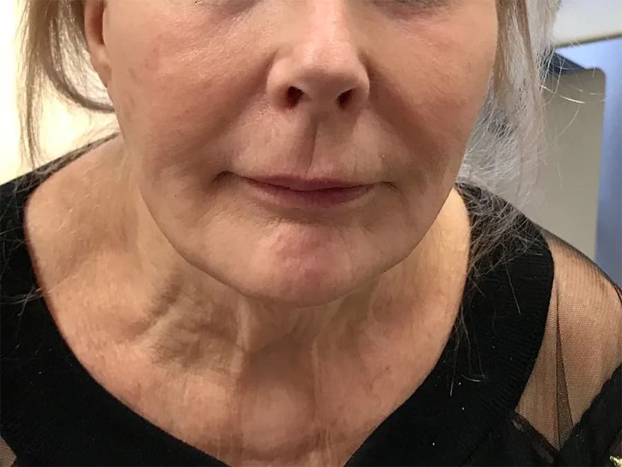 Facial filler, lower face and jawline, before