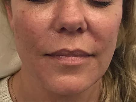 Facial filler, cheeks and lower face, after