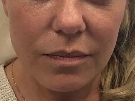Facial filler, cheeks and lower face, before