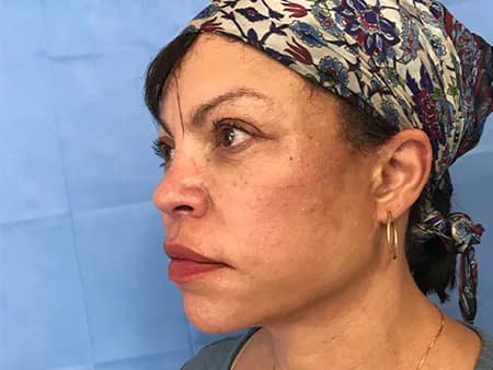 Cheek and midface filler, side view, before