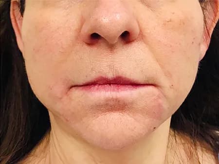 Filler for smile and marionette lines, after