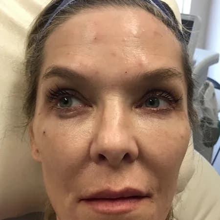 Facial filler, full face, after
