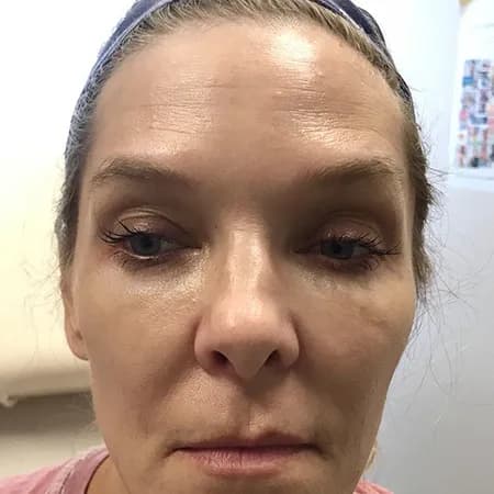 Facial filler, full face, before
