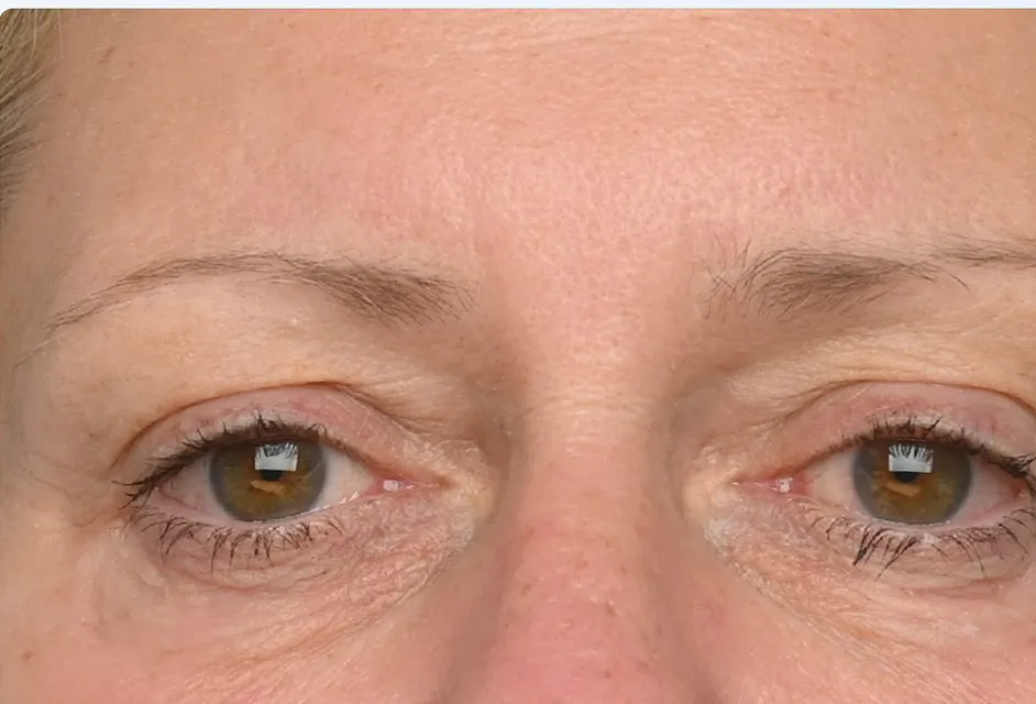 EMFACE Eyes, under-eye area, after the fourth treatment, after