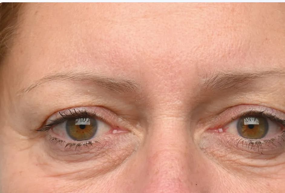 EMFACE Eyes, under-eye area, after the fourth treatment, before