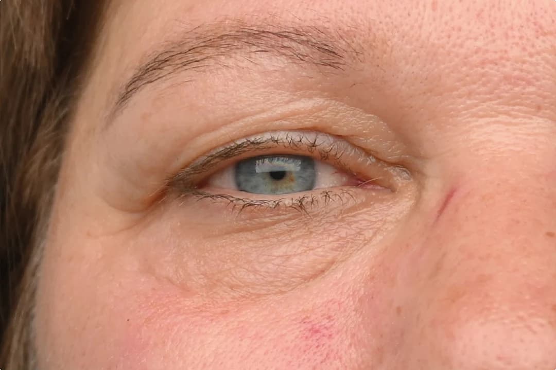 EMFACE Eyes, under-eye bags and crow's feet, after