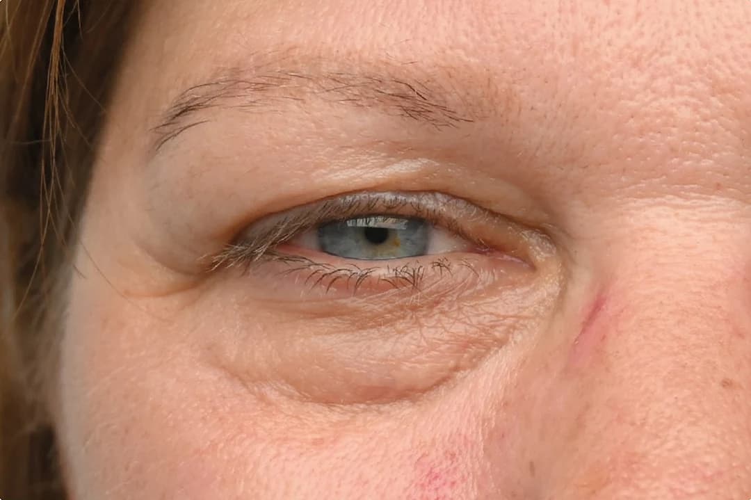 EMFACE Eyes, under-eye bags and crow's feet, before