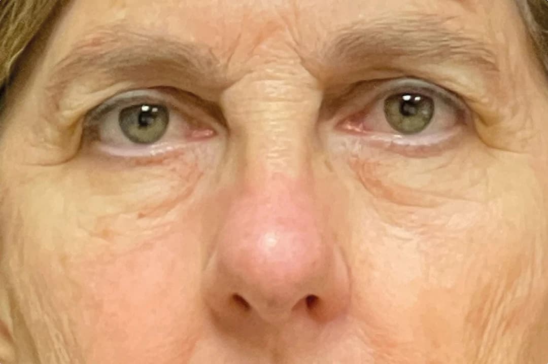EMFACE Eyes, under-eye area, both eyes, after