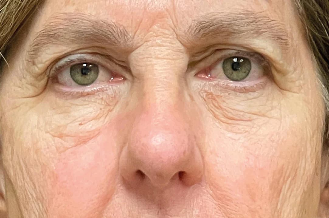 EMFACE Eyes, under-eye area, both eyes, before