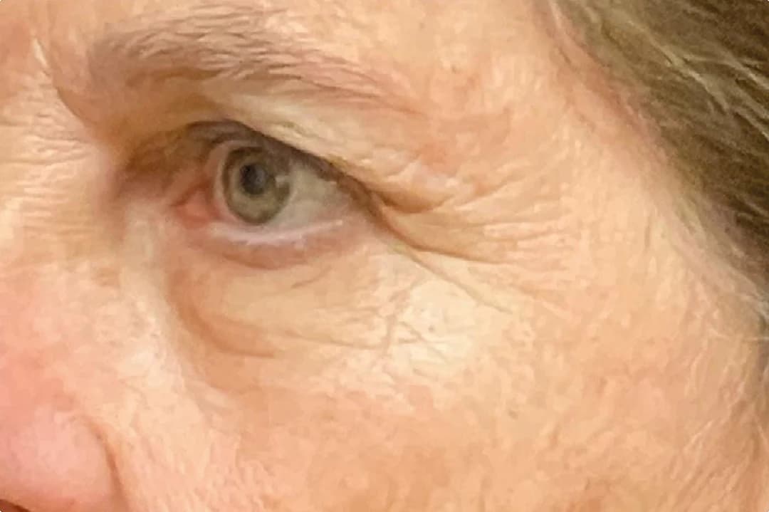 EMFACE Eyes, crow's feet, side view, after