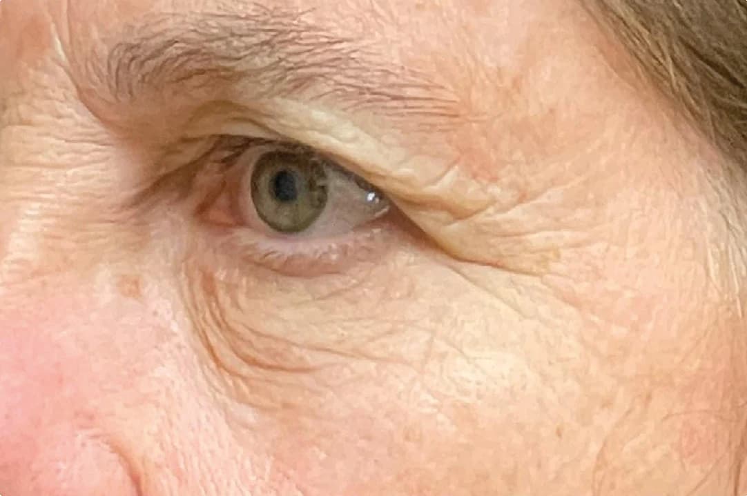 EMFACE Eyes, crow's feet, side view, before